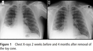 Radiografía del hombre. BMJ Case Reports